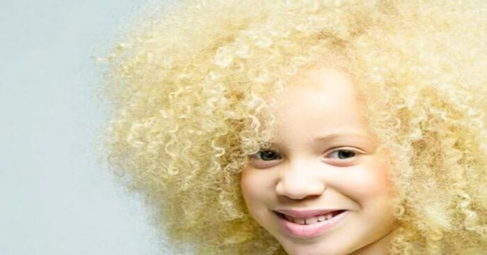 Cette fille albinos africaine a une apparence unique  c’est ainsi qu’elle a transformé sa beauté en dignité