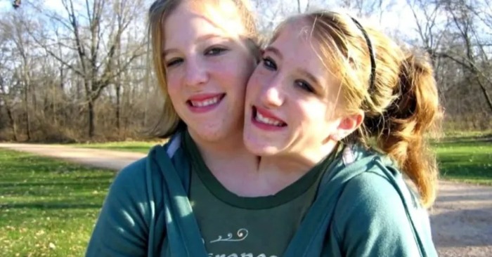  Une histoire intéressante de jumeaux siamois: voici à quoi ressemblent les sœurs Hensel uniques aujourd’hui