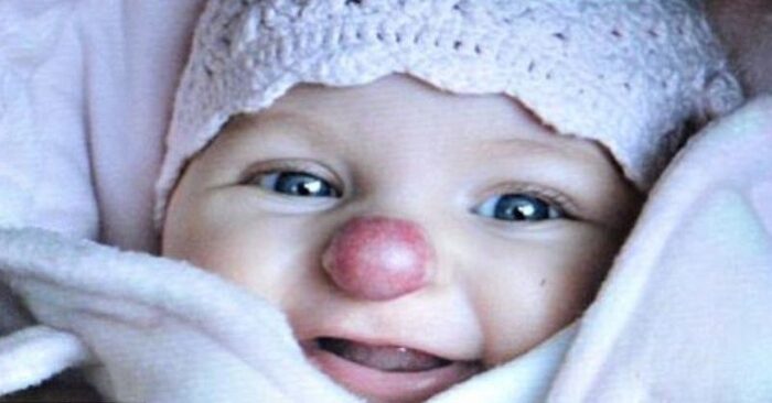  Un bébé insolite: voilà à quoi ressemble une fille unique qui est née avec un nez insolite