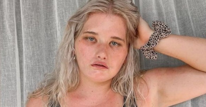  «Elle ne peut même pas sourire»: 24 ans Tyla Clement a une paralysie faciale du nerf facial